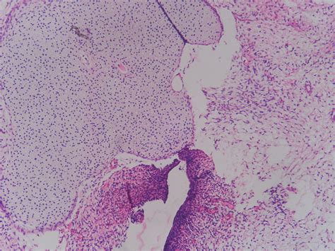 SARCOMA BOTRYOIDES (EMBRYONAL RHABDOMYOSARCOMA ) – CERVIX ...