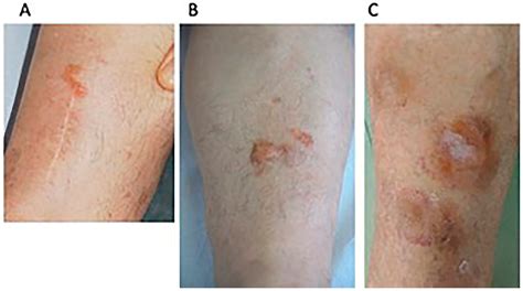 Dermatopathology Free Full Text Primary Localized Cutaneous Nodular Amyloidosis And Limited