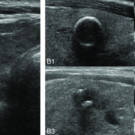 Malignant Thyroid Nodules Ultrasound