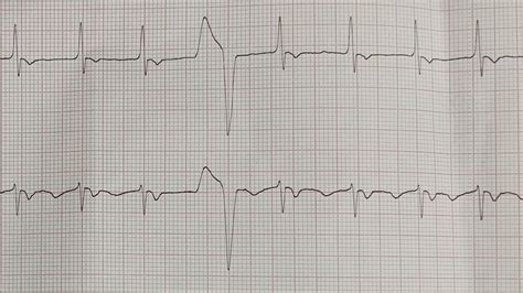 Intraventricular Conduction Delay BUNDLE BRANCH BLOCKS YouTube