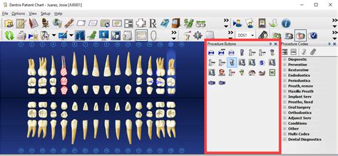 Perio Charting Code A Visual Reference Of Charts Chart Master