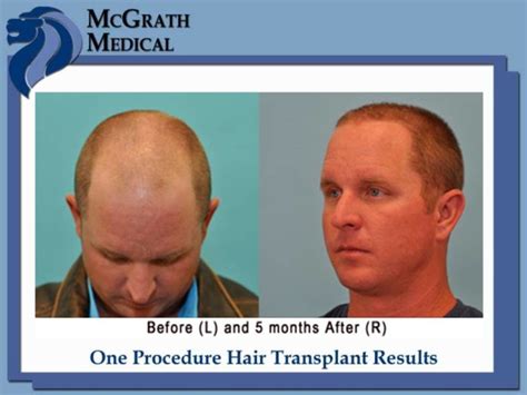 Before & After Hair Transplant Photos - Houston Hair Restoration