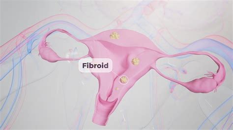 Uterine Fibroid Symptoms Signs And Treatment Options