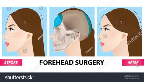 forehead plastic surgery   vector stock vector royalty