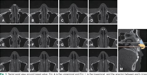 Figure 1 From Definition Of Nasal Valve Location And Classification Of