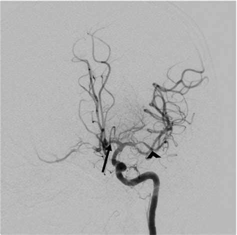 Acute Bilateral Internal Carotid Artery Occlusion A Novel Approach To