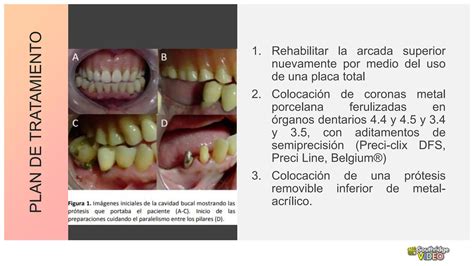 Aditamentos Protesis Removible Dentales Ppt