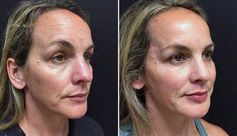 Injectables Fillers Before And After Pictures Case Alpharetta