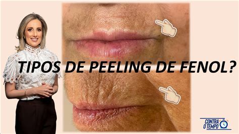 Nova Vis O Do Peeling De Fenol Conhe A Os Tr S Tipos Superficial