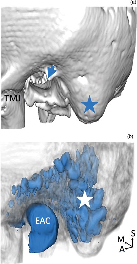 Mastoid Air Cells