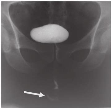 Retrograde Urethrography Revealing A Urethral Fistula Arrow Figure