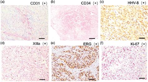 Figure From Extensive Cutaneous Iatrogenic Kaposis Sarcoma After