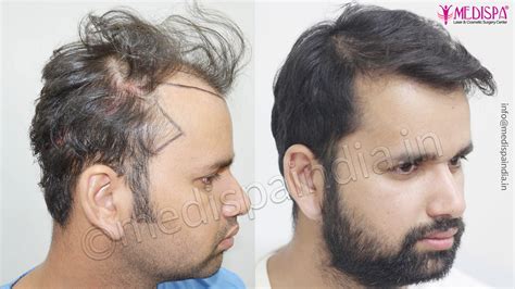 Australia Hair Transplant Result Hair Transplant Dubai Cost