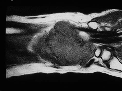 Synovial Sarcoma Soft Tissue Sarcoma