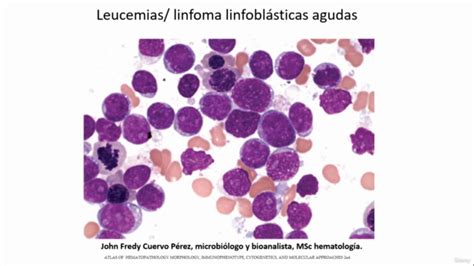 Aprende Leucemia Linfoma Linfobl Stica Aguda