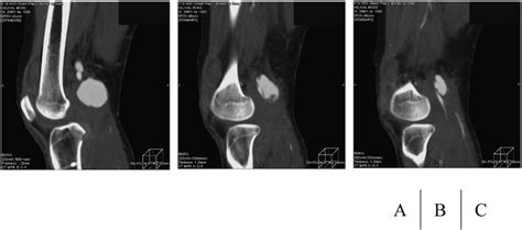 A Preoperative Contrast Enhanced Computed Tomography Sagittal View