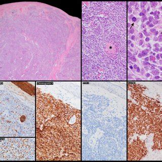 Merkel Cell Carcinoma Histological Features With Its Typical