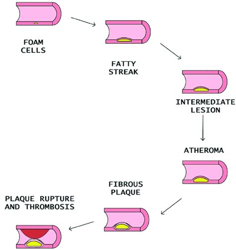 Steps of atheromatous plaque formation, progression, and rupture ...