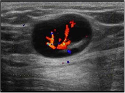 Groin Lymph Node Ultrasound