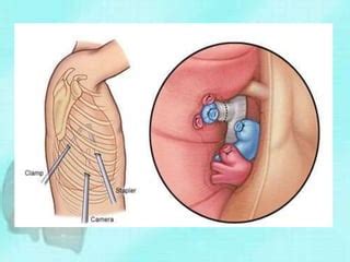 Lung cancer surgery | PPT