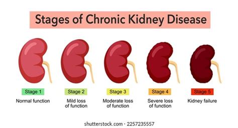 Chronic Kidney Disease Stages Symptoms And Treatment 44 Off