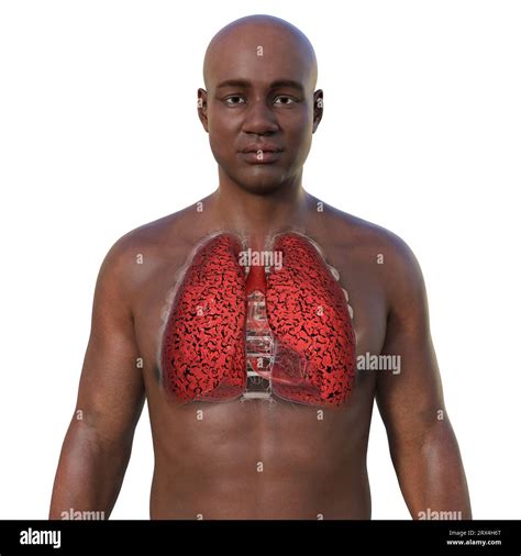 Smoker S Lungs Illustration Stock Photo Alamy