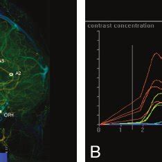 A Lateral View Of A Color Coded Right Carotid Artery DSA Of A Control