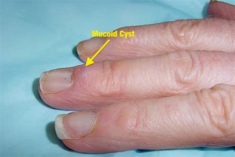 MUCOUS CYST Hand Surgery Resource