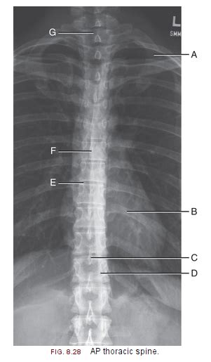 Ap Thoracic Spine Radiograph Diagram Quizlet