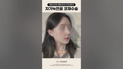 코성형 하나로 이렇게 이미지가 달라진다고😮 자가늑연골 코재수술 후기 코재수술후기 Youtube