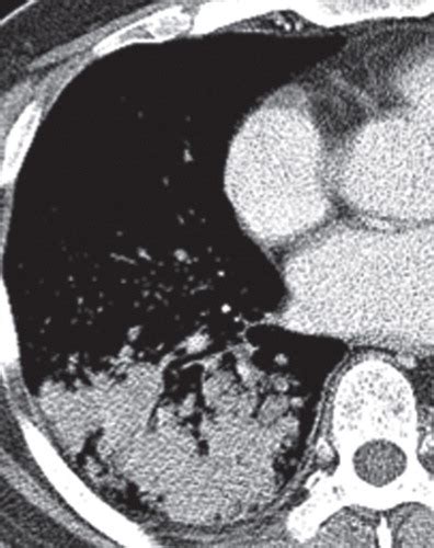 Radiologic Implications Of The 2011 Classification Of Adenocarcinoma Of The Lung Radiology