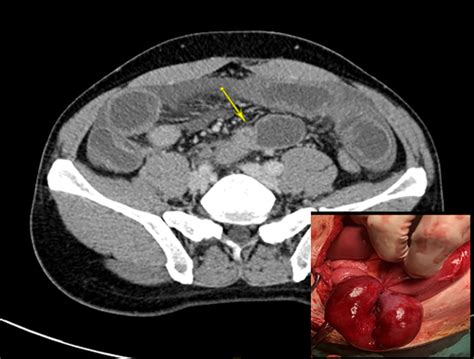 Adhesive Small Bowel Obstruction An Update Tong 2020 Acute Medicine And Surgery Wiley