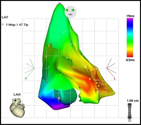 Para Hisian Atrial Tachycardia Cardiac Electrophysiology Clinics