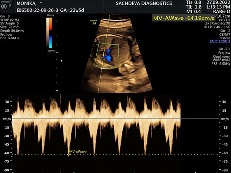 Color Doppler Sachdeva Diagnostics