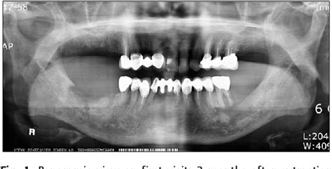 Figure 1 From Osteoradionecrosis Of Jaw In Head And Neck Cancer Patient