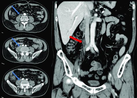 Breast Cancer With Ureteral Metastasis The Blue Arrows Indicate