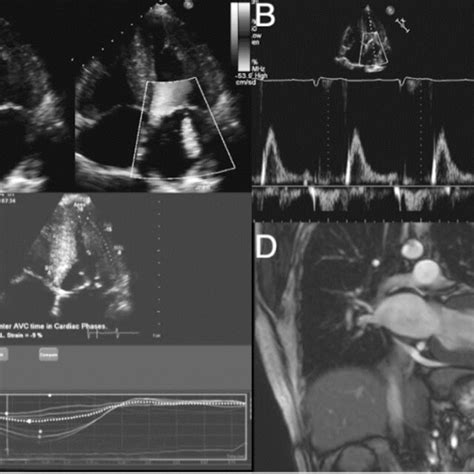 Cardiac Amyloidosis A Apical 4 Chamber View Of An Echocardiogram