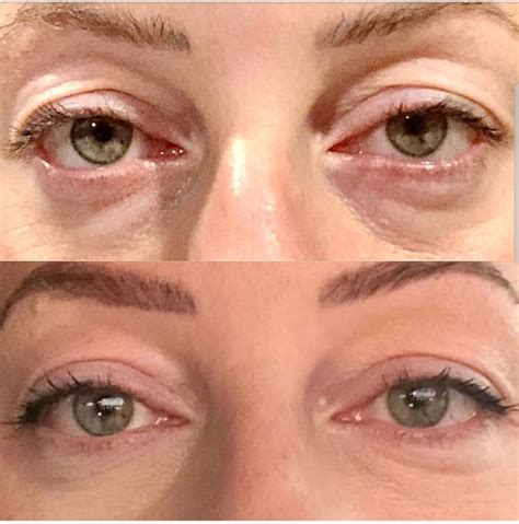 Non Surgical Blepharoplasty Eyelid Lift Without Surgery Vink