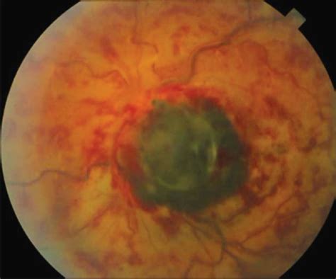 Melanocytoma Of The Optic Disk A Review Pmc