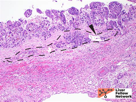 Pathology Pearls Hepatocellular Carcinoma Aasld