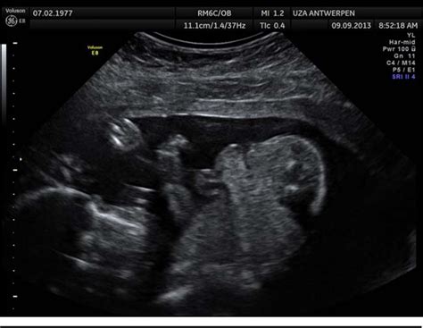 Figure 2 From Bladder Exstrophy Epispadias Complex And Triple X Syndrome Incidental Finding Or