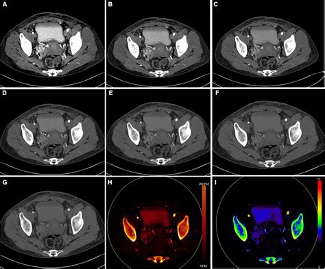 Frontiers Diagnostic Value Of Dual Energy Ct And Clinicopathological