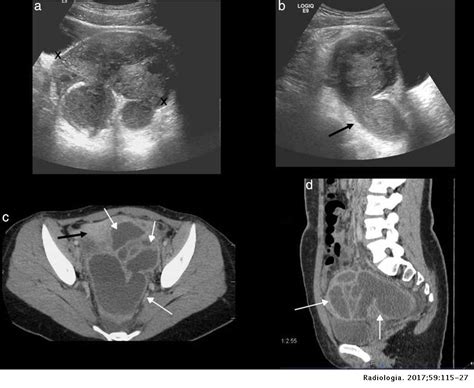 Gynecological Pelvic Pain As Emergency Pathology Radiología English