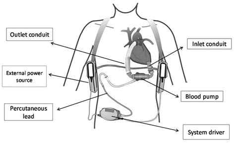 Heart Mate Ii Left Ventricular Assist Device Lvad An Axial Flow