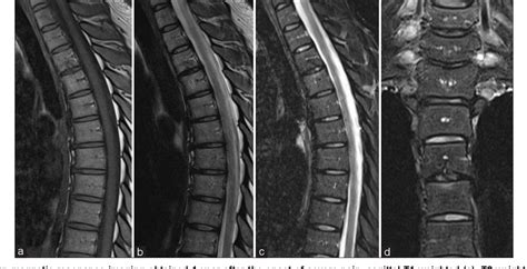 Figure 4 From Acute Calcific Discitis Or Symptomatic Calcified Schmorl S Node Of The Upper