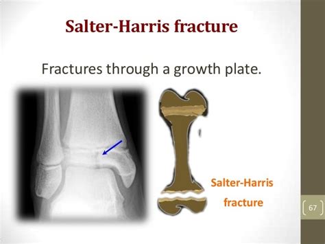 What Is The Icd 10 Cm Code For Tibia Fracture Fibula Right