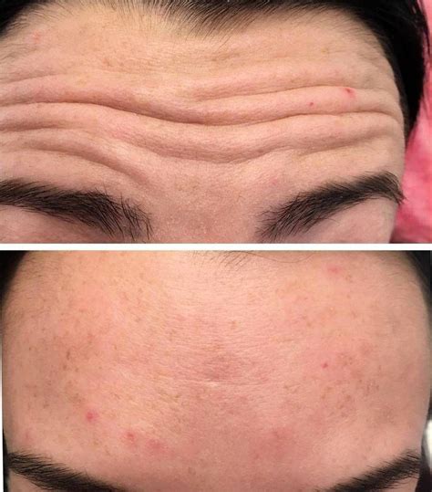 Botox Forehead Lines Before And After Botox Facelift Botox Botox Forehead