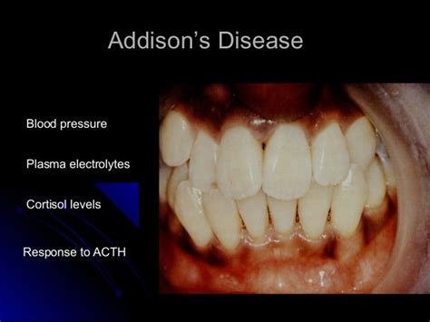 Oral Diagnosis And Systemic Diseases