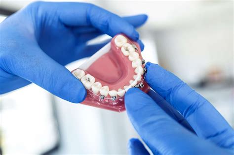 Self Ligating Braces In Richardson Texas Cost Pros Cons