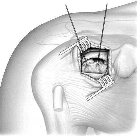 Pdf Arthroscopic Assisted Rotator Interval Closure